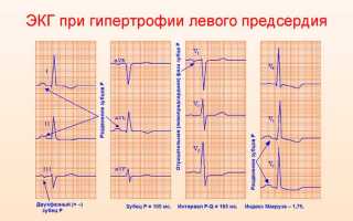 Увеличение левого предсердия что это такое