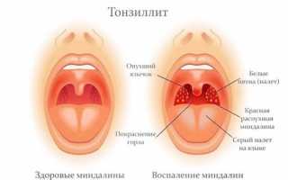 Когда при ангине нужны антибиотики?