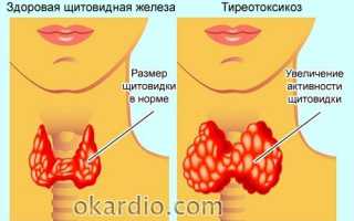 Дистрофия миокарда что это такое
