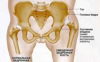 Что представляет из себя тазобедренный сустав?