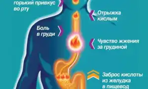 Что такое изжога