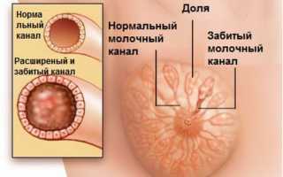 Причины возникновения лактостаза: лактостаз груди