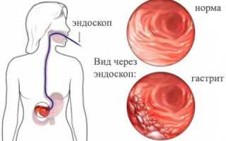Гастрит и язва желудка: что это такое и чем они опасны?