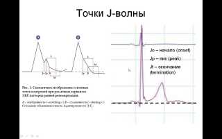 Ранняя реполяризация желудочков