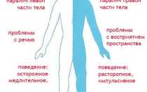 Обширный инсульт последствия шансы выжить реабилитация