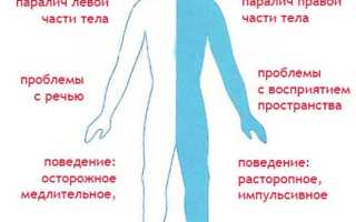 Обширный инсульт последствия шансы выжить реабилитация