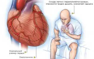 Хроническая сердечная недостаточность стадии