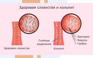 Причины, клиническая картина и методы лечения кольпита при беременности