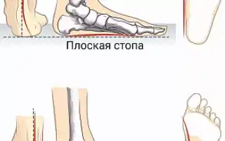 Комплексное лечение проблемы: плоскостопие у детей
