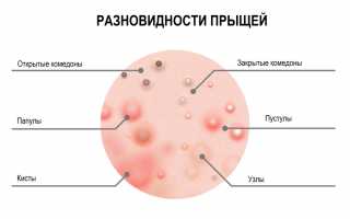 Как выглядят простудные прыщи: простуда на лице