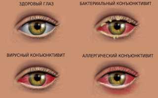 Причины развития аллергических конъюнктивитов