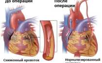 Аортокоронарное шунтирование послеоперационный период