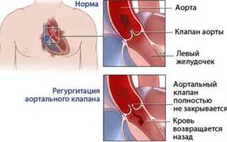 Пролапс митрального клапана у ребенка